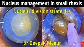 Phaco Basics: Phacoemulsification in small rhexis, Strategies for Nucleus division-Dr Deepak Megur