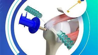 Canwell Medical Training Course - Rotator Cuff Repair Using CanPEEK Anchor