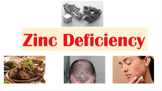 Zinc Deficiency | Dietary Sources, Causes, Signs & Symptoms (ex. Hair Loss), Diagnosis, Treatment