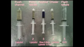 GASTRIC VARICEAL BLEED: HISTOACRYL GLUE AND TIPSS