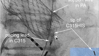 How to use a long sheath for Conduction System pacing with instructions on sheath removal