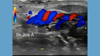 Varicocele grade 3 in young adolescent boy - ultrasound and color Doppler video