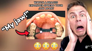 This Braces Expander Will Change Your Jaw AND Face