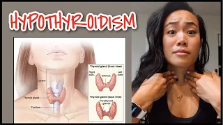 HYPOTHYROIDISM - What You Need to Know | Doctor Mom