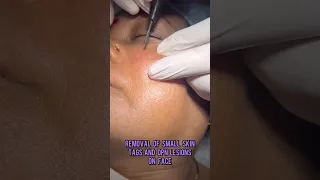 Remove of small skin tags and DPN lesions on face.