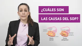 ¿Cuáles son las causas del Síndrome de Ovarios Poliquísticos (SOP)?