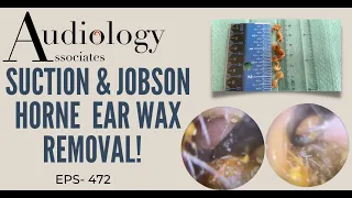 SUCTION & JOBSON HORNE EAR WAX REMOVAL - EP472