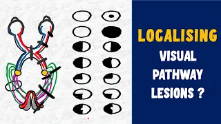 LESIONS OF VISUAL PATHWAY || SCOTOMAS EXPLAINED|| Junctional scotoma|| HOMONYMOUS HEMIANOPIA