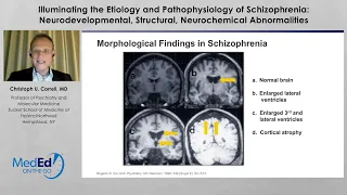 Etiology & Pathophysiology of Schizophrenia: Neurodevelopmental, Structural, Neurochemical