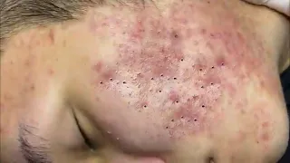 Relax everyday with Blackheads 0520