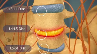 Herniated Disc 3d medical animation