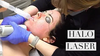 Halo Laser Treatment For Acne Scars: Nikki Gets A New Face!