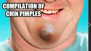 Chin Zits!  Chin Blackheads, Chin Pimples and Pimple Pops!