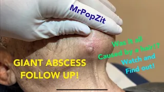 Giant chin abscess follow up! Was it all caused by a HAIR!? See the interesting dissection here!