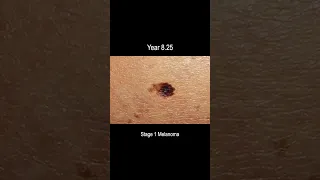 Melanoma Skin Cancer Development Time Lapse (Normal to Stage 4 Melanoma Over 10 Years)