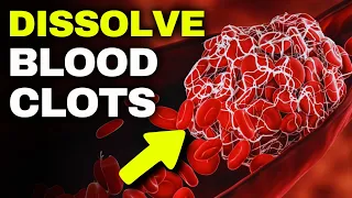 BLOOD CLOTS Natural Remedies, Top 7 FOODS That Dissolve Blood Clots