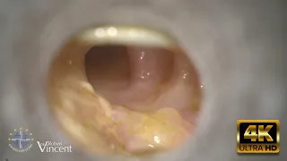 Total TM Perforation- Type 1 Tympanoplasty with Total Flap Removal Technique