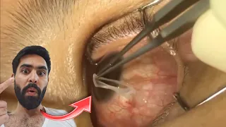 Surgical Removal of Subconjunctival Thelazia | hard and strange eyes