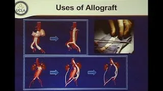 Aortic Graft Infection: Contemporary Management of a Resurgent Problem - Binkley Lecture