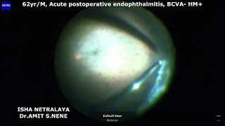 Acute post operative endophthalmitis-Aggressive management is the key