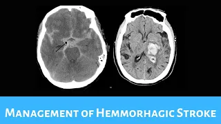 Management of Hemorrhagic Stroke