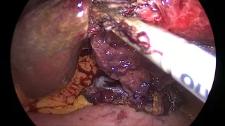 Laparoscopic Hepatic Cystectomy