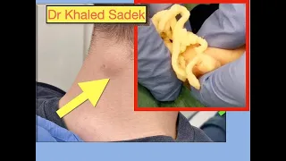 Neck Cyst. Dr Khaled Sadek