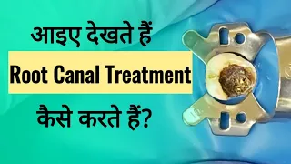 What Is Root Canal Treatment #RCT l RCT on Tooth in Hindi