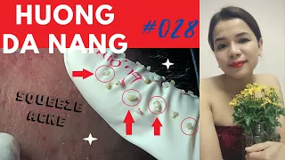 #028 | Nhat part 6 | Super SQUEEZE ACNE asmr | Yêu nặn mụn | trattamento acne