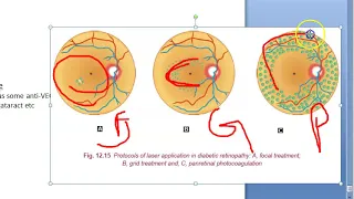 Ophthalmology 285 d Treatment of Diabetic Retinopathy focal grid pan retinal photocoagulation  VEGF