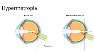 Hypermetropia causes, optics, sign and treatment