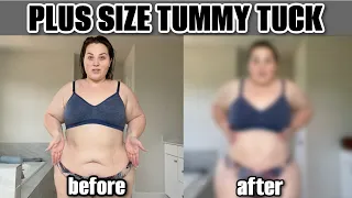 Before & After a Plus Size Tummy Tuck (Dr. Repta)