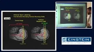 Introducing MRI: Arterial Spin Labeling (54 of 56)