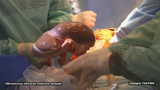 Серце, дві нирки й вилучена печінка - друга поліорганна трансплантація у Волинській обласній лікарні