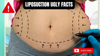 5 Unbearable Truths About Liposuction That Nobody Never Talks About