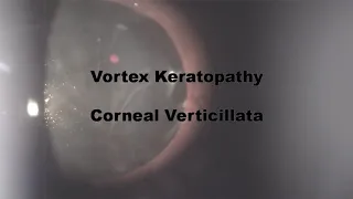 Vortex Keratopathy : Clinical Peanuts 🥜