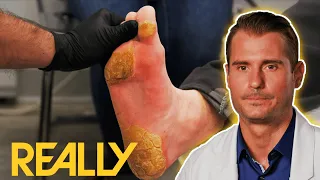 "I've Never Seen Calluses This Big Before!" | My Feet Are Killing Me