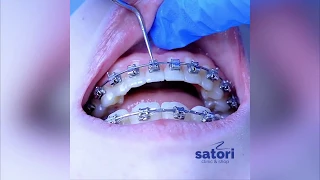 Снятие брекетов | стоматология  Самара | braces off