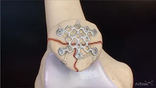 Patella Fracture Repair Using the Arthrex Mesh Plating System