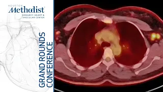 Acute & Chronic Cardiac Involvement in COVID-19 Infections (Al-Mallah MD, Malahfji MD) 12/16/21