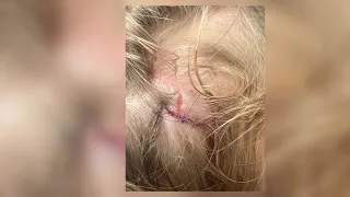 6 year old attacked by pit bull in White City, saved by 9 year old brother