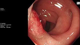 TRICKY LESION IN SIGMOID DIVERTICULAR SEGMENT