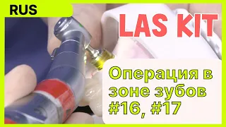 [Практические советы] LAS KIT - Операция в зоне зубов #16, #17