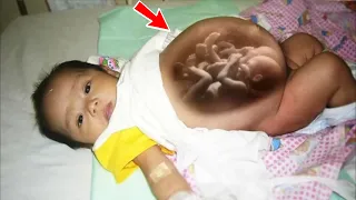 This has never happened in history! The girl was born pregnant with twins!