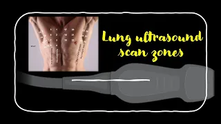 Lung ultrasound scan zones POCUS (slideshow) - Dr. Koratala (@NephroP)