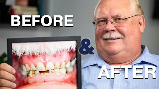 Dental Implants Before & After