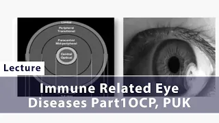 Immune Related Eye Diseases Part 2 Scleritis, Episcleritis