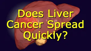 Does Liver Cancer Spread Quickly