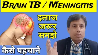 Brain TB // Tubercular Meningitis // TBM // Tuberculoma // Dr Sanjay chest specialist