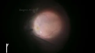 Retinal Cavernous Haemangioma